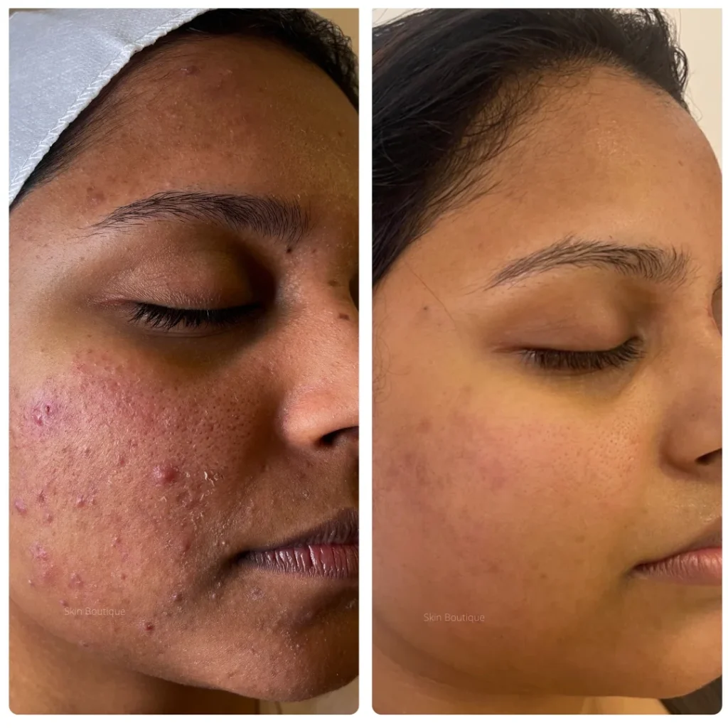 microneedling treatment