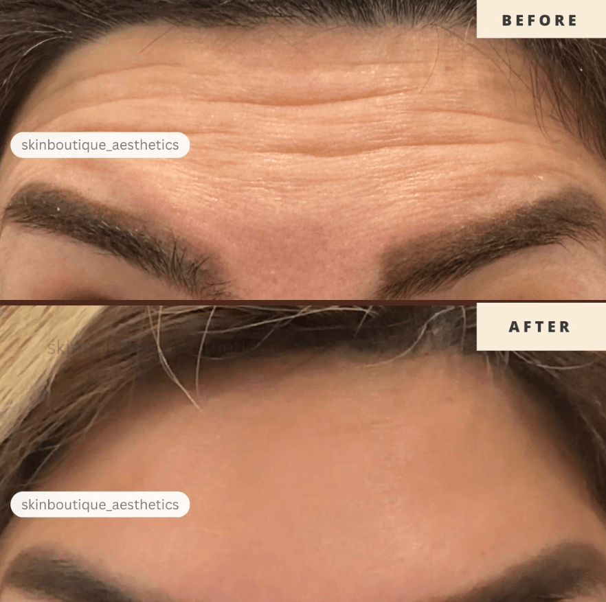 botox treatment Billericay
