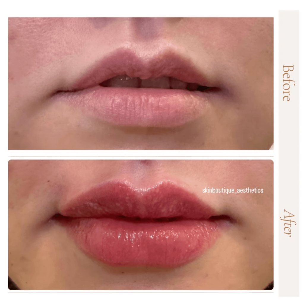lip enhancements Clacton