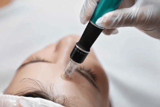 microneedling treatment Basildon