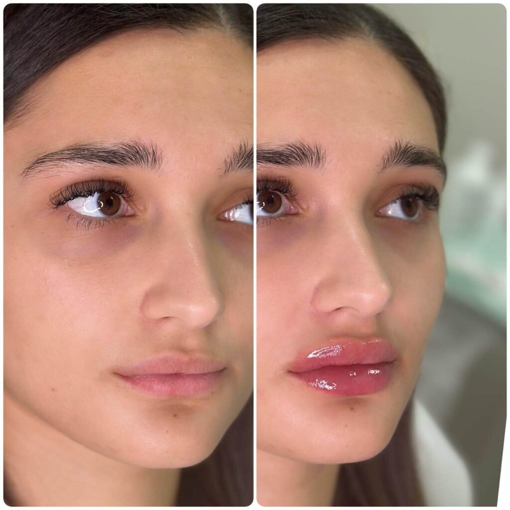 lip fillers